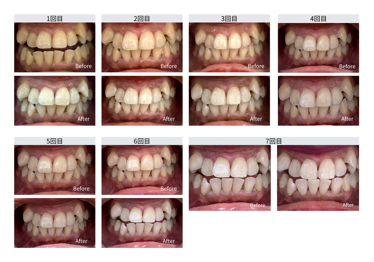ホワイトニング 施術前／施術後イメージ